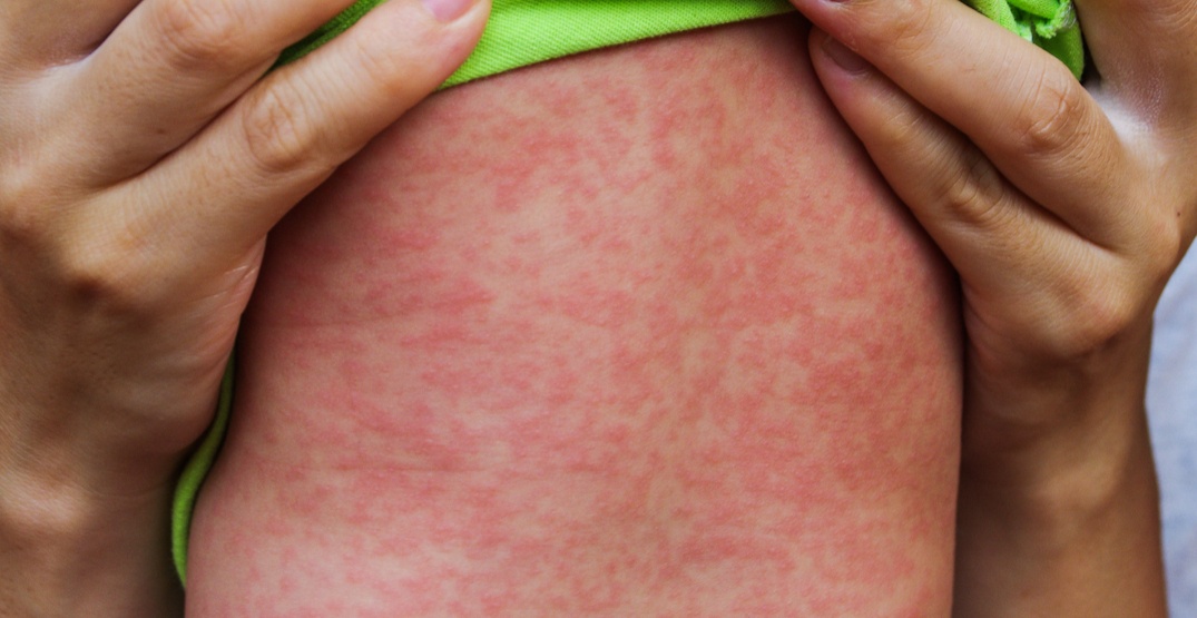 Vancouver Coastal Health reports new measles cases bringing total to 15