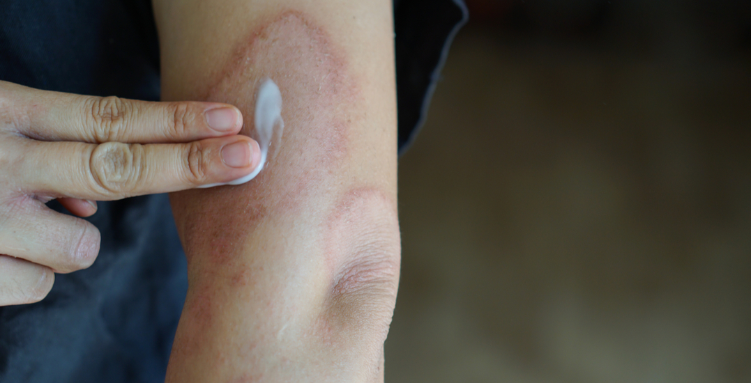 Anti-itch cream recalled nationally due to mislabeling: Health Canada