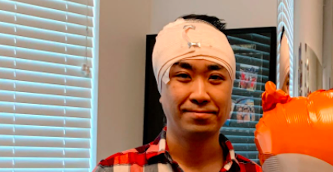 Man left with stitches in head after daylight attack in downtown Vancouver
